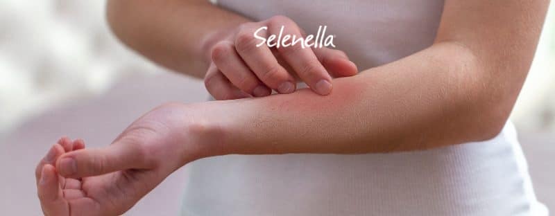 Punture di insetto: prevenzione e rimedi - Il Blog di Selenella